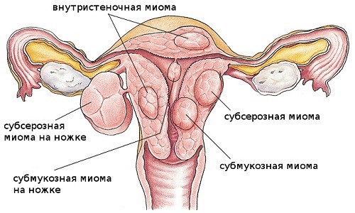 Миомы матки