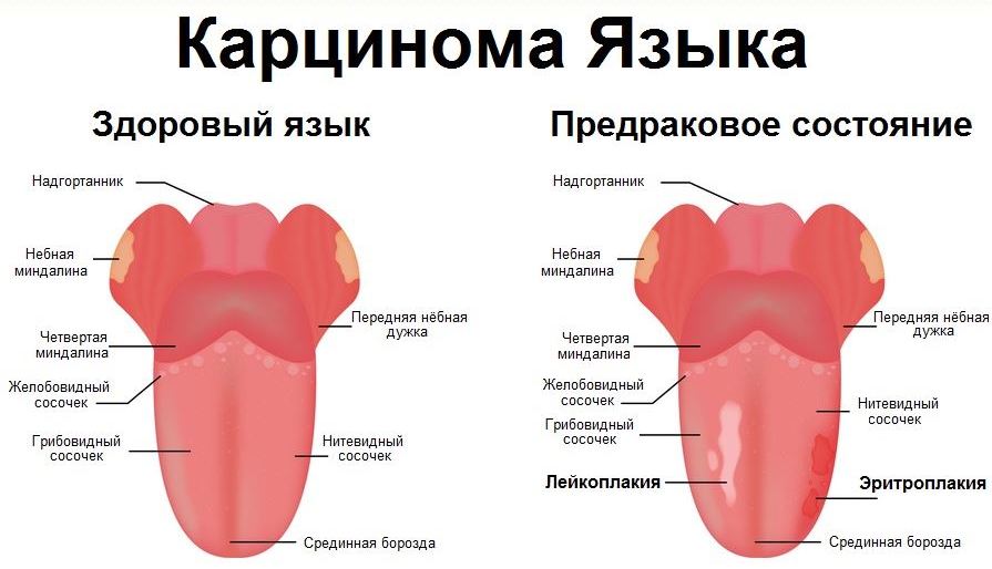 рак языка